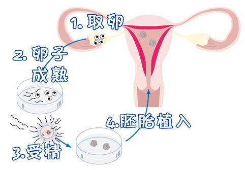胚胎着床出血